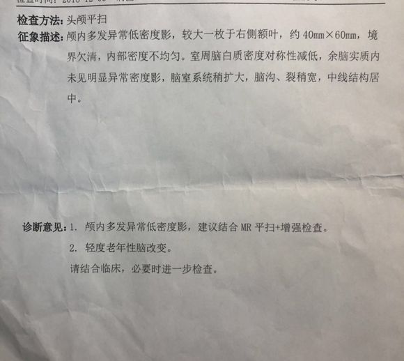 乳腺癌脑转移